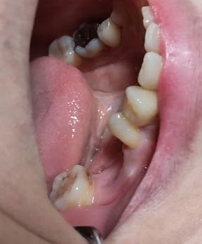 ヒューマンブリッジ症例15セット前の様子