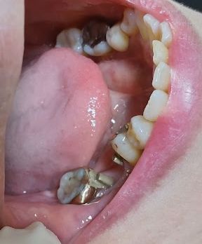 ヒューマンブリッジ症例15パーツをセット