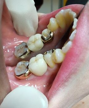 ヒューマンブリッジ症例15ポンティックをセット